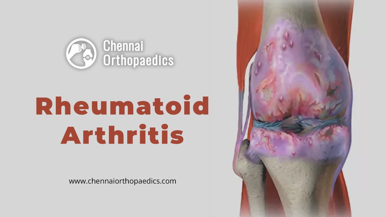 Rheumatoid arthritis treatment  @ Dr Bharani  Kumar Dayanandam