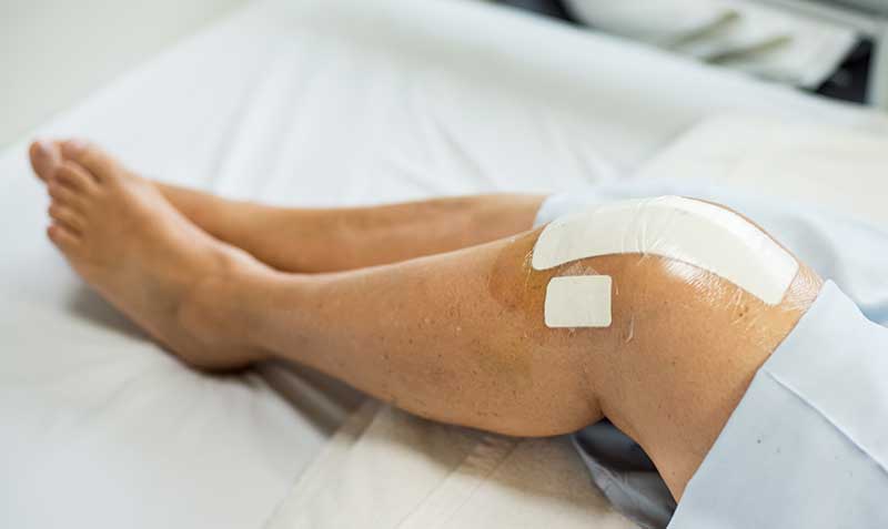 Partial knee replacement surgery incision with postoperative dressing