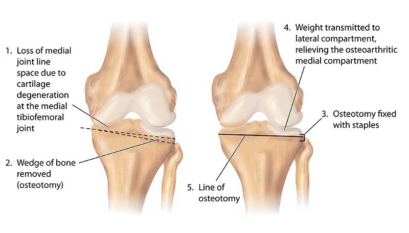 Knee Osteotomy Surgery in Chennai for Knee Alignment