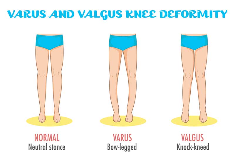 Knee Deformity: Causes, Types, Symptoms, and Treatment