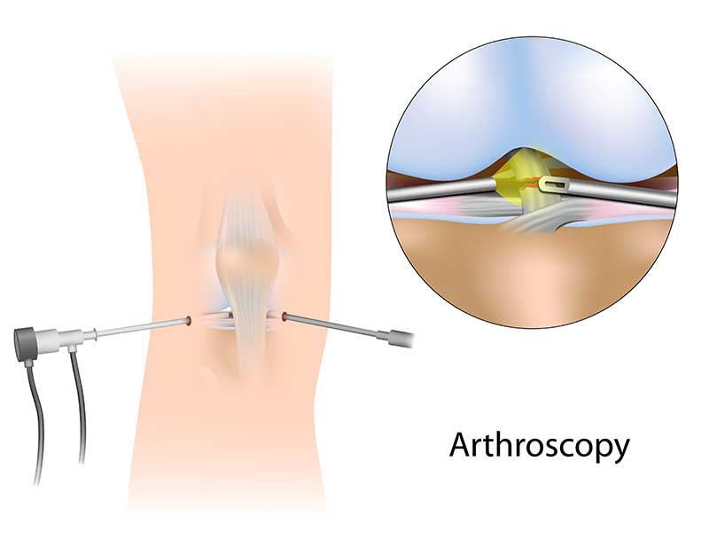 Arthroscopic knee surgery