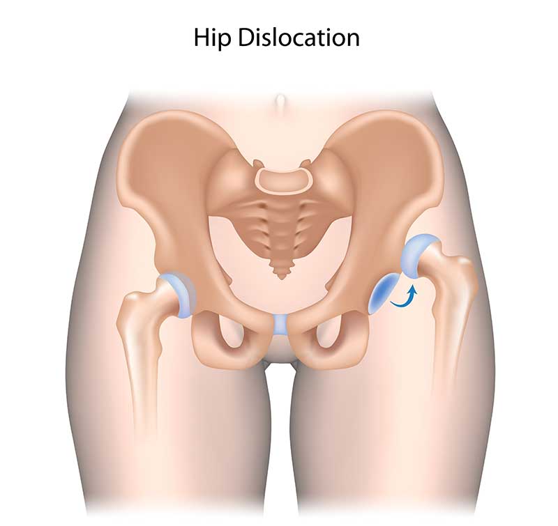 Hip dislocation treatment in Chennai