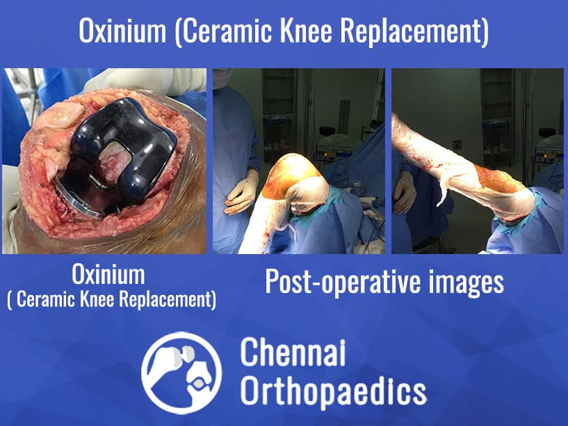 ceramic knee replacement