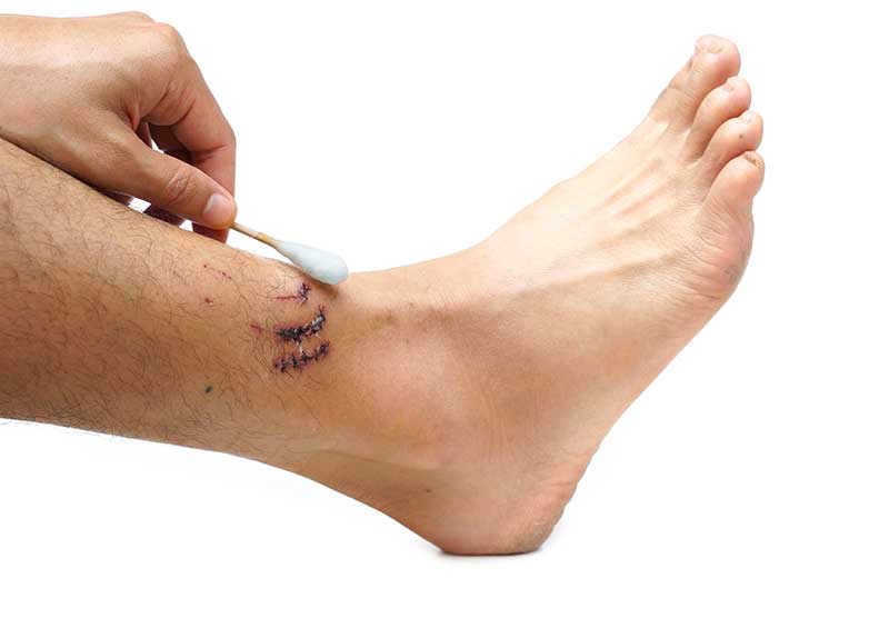 chennaiorthopaedics - chennaiortho Ankle Fracture Treatment in Chennai