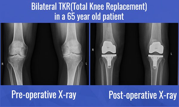 knee replacement surgery