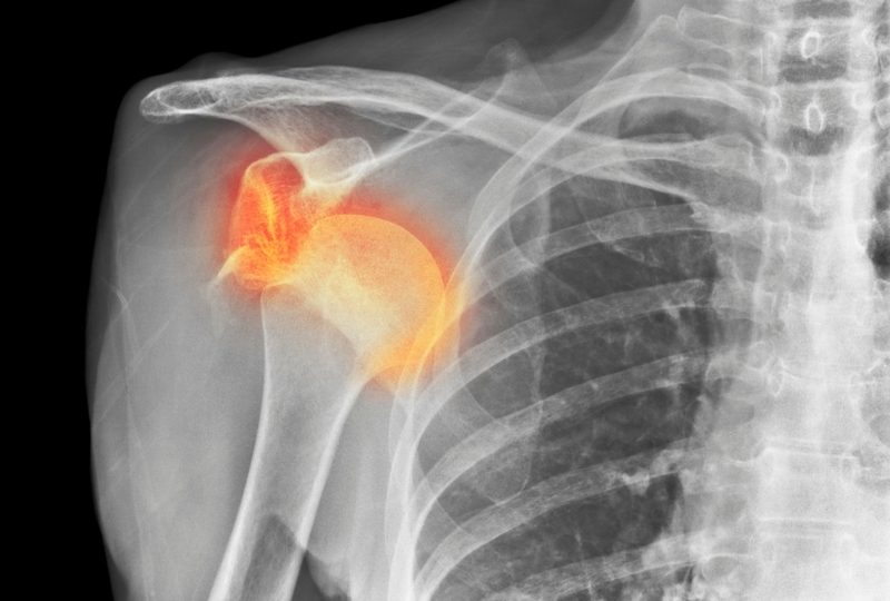 Pain After a Shoulder Dislocation? When It’s Normal and When It’s Not
